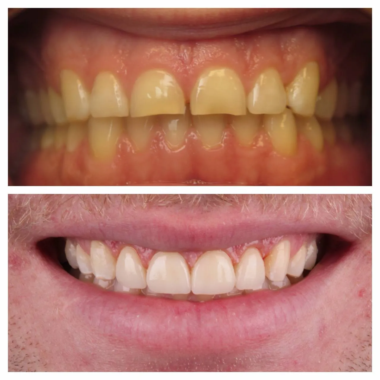 Porcelain matched to skin, age, and jaw. Nothing announces itself.