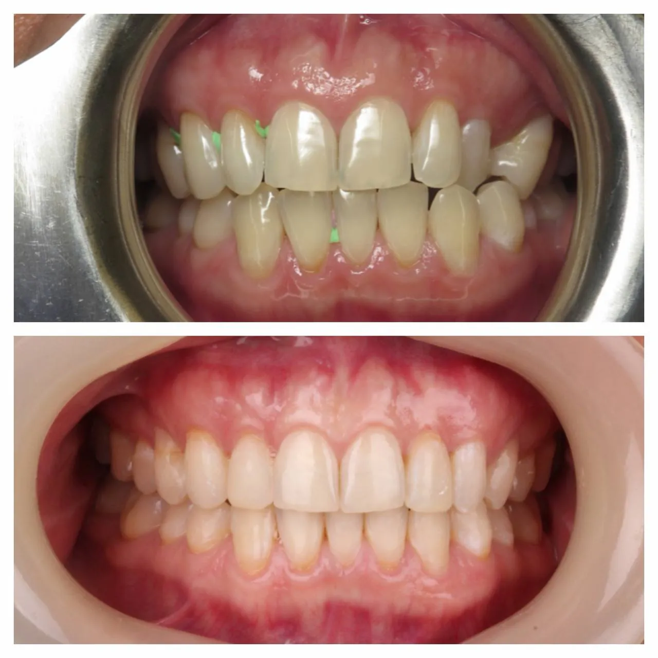 Invisalign and whitening. No enamel touched.