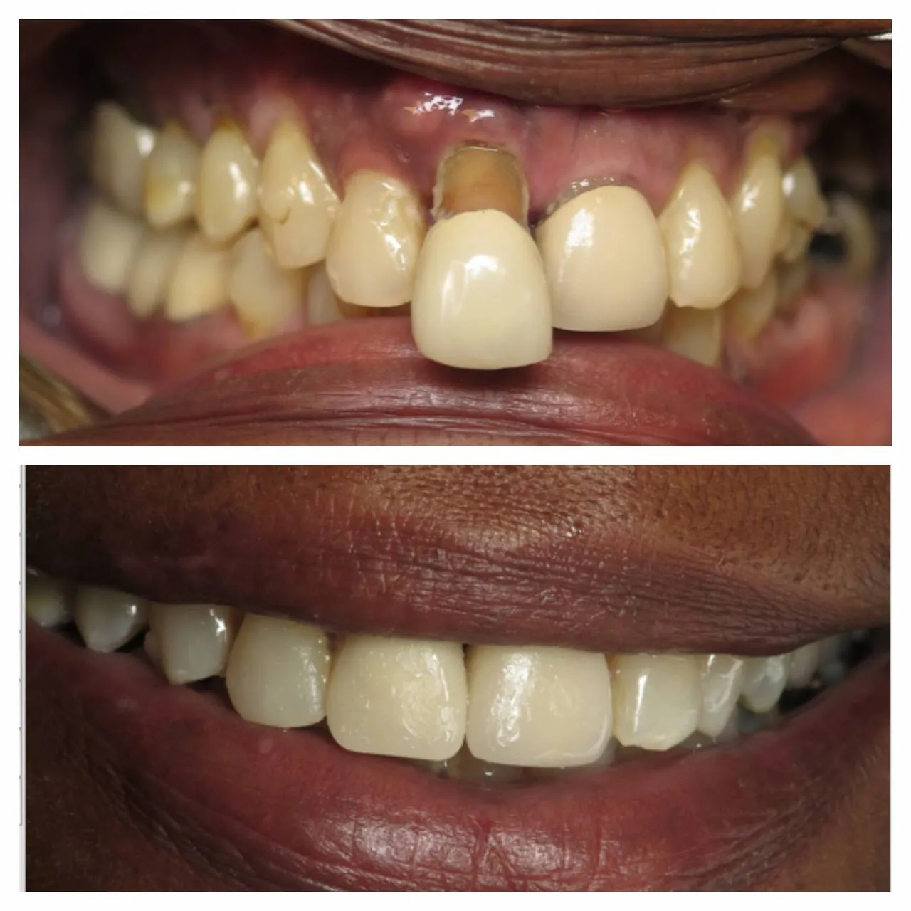 Full-mouth rehabilitation, planned around bite and bone first.