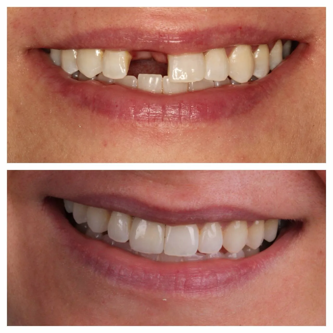 Trauma case — front tooth restored with implant and veneers.