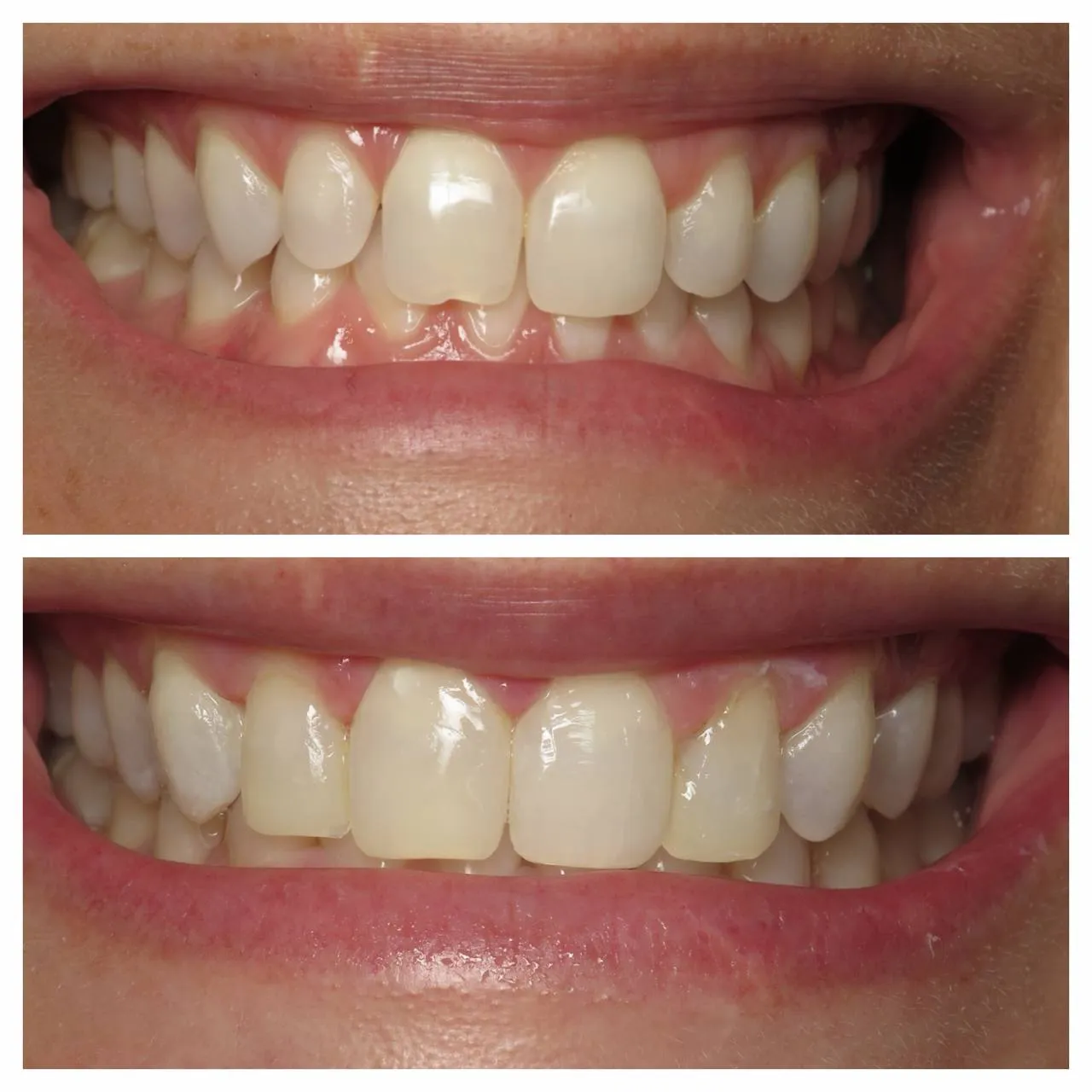 Quarter-millimeter shape changes that quiet the smile.