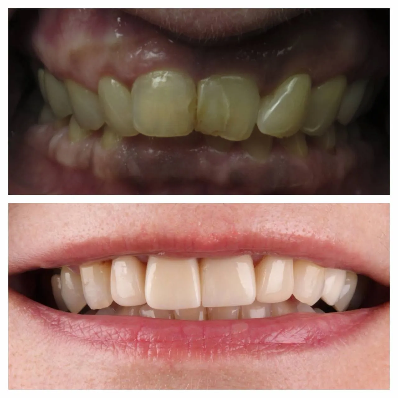Long-standing yellow staining, resolved in a single visit.