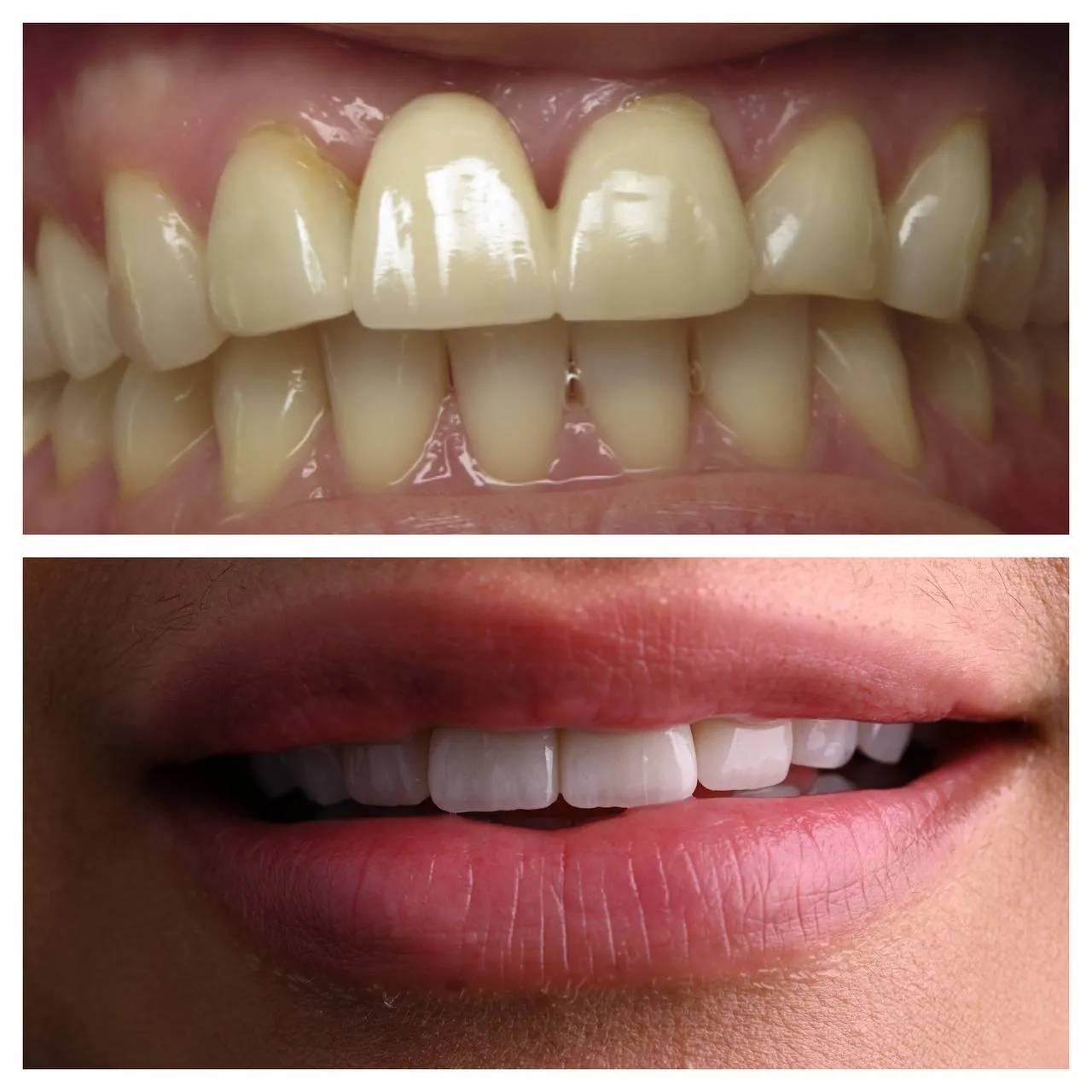 Warm, worn dentition, brought back to a bright, even line.