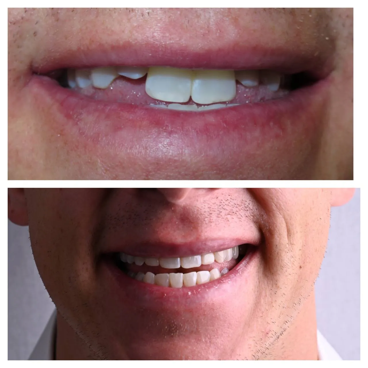 A small tooth built to full width; the smile finally filled the frame.