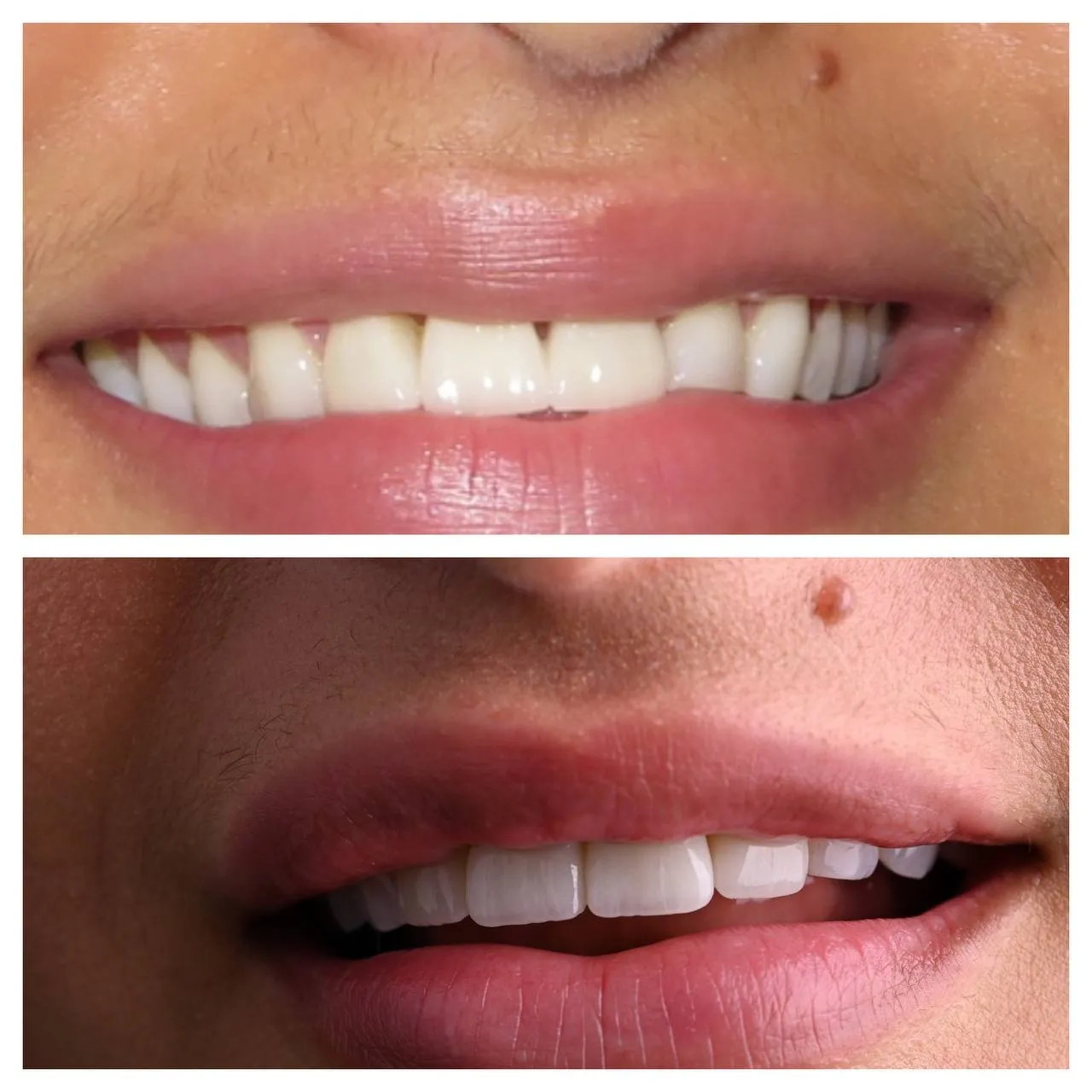 Small gaps across the front teeth, closed with porcelain.