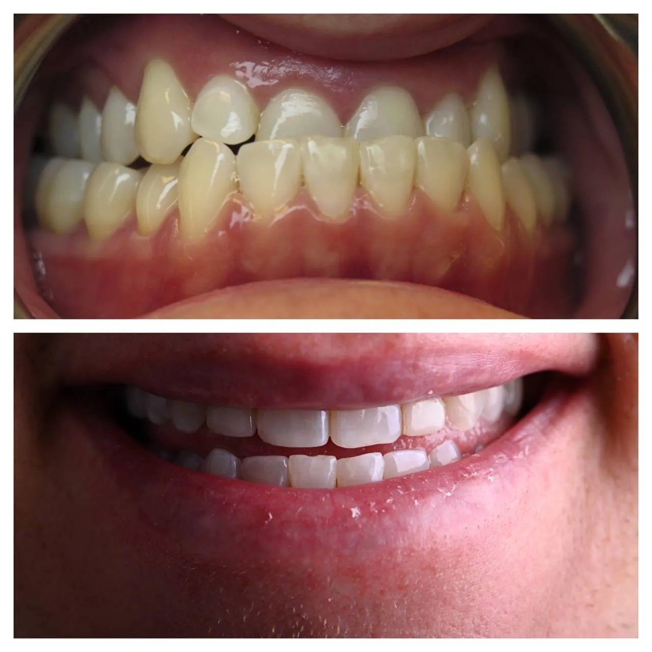 A rotated front tooth, brought back into line with porcelain instead of braces.