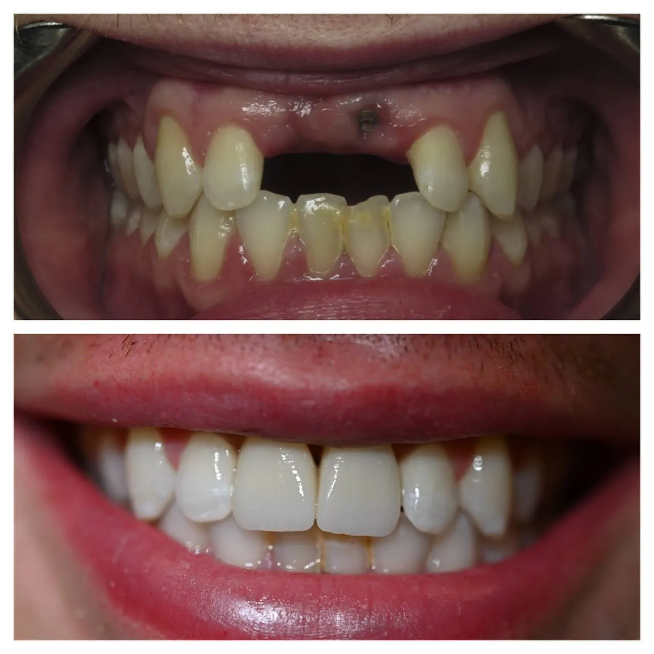 A missing front tooth, replaced with a single implant crown.