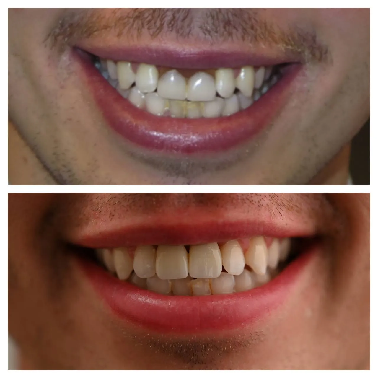 Years of wear rebuilt in porcelain, without changing the character of the face.