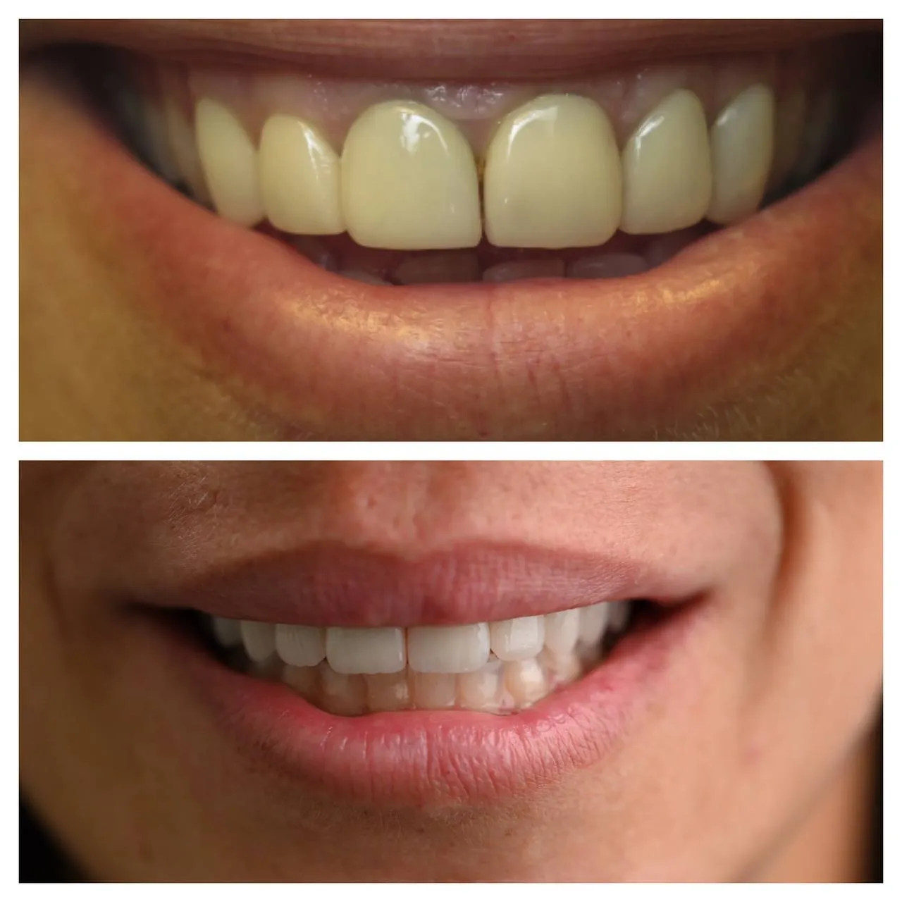 Older restorations retired; the smile brought forward to today.